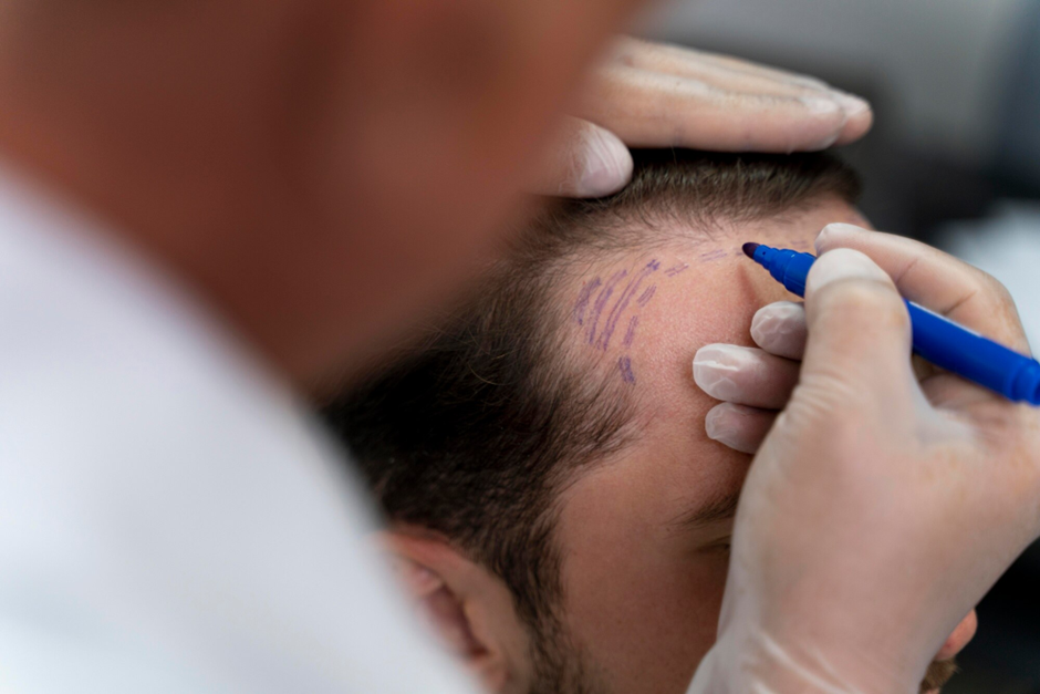 Recovery Process After DHI Hair Transplant In Sydney